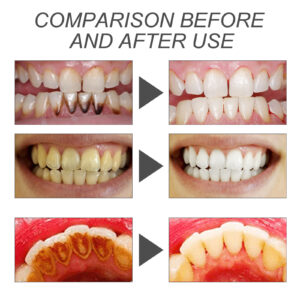  Before and after results using bamboo charcoal teeth whitening powder showing whiter teeth